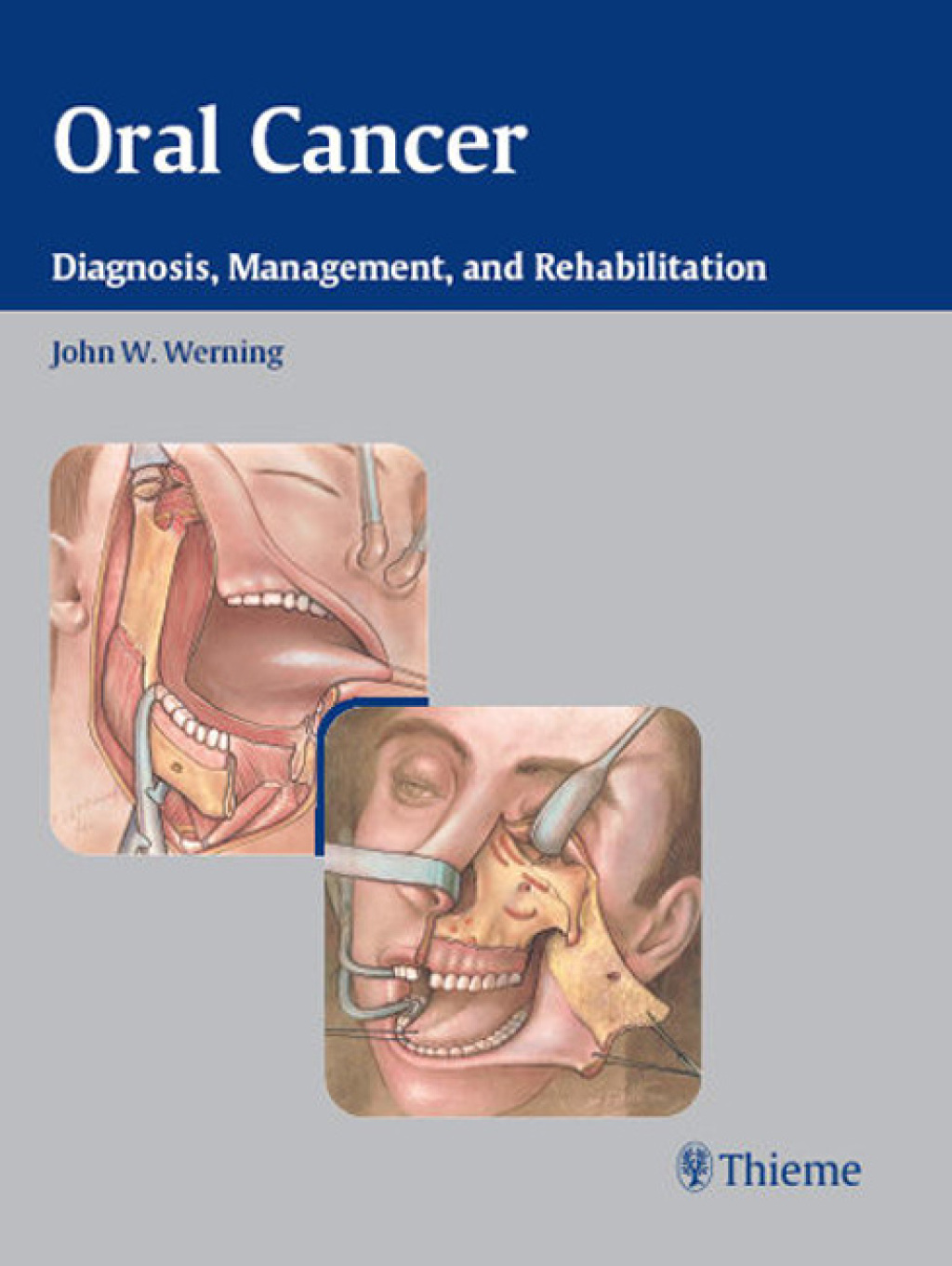 Oral Cancer Diagnosis, Management, and Rehabilitation 1st Edition