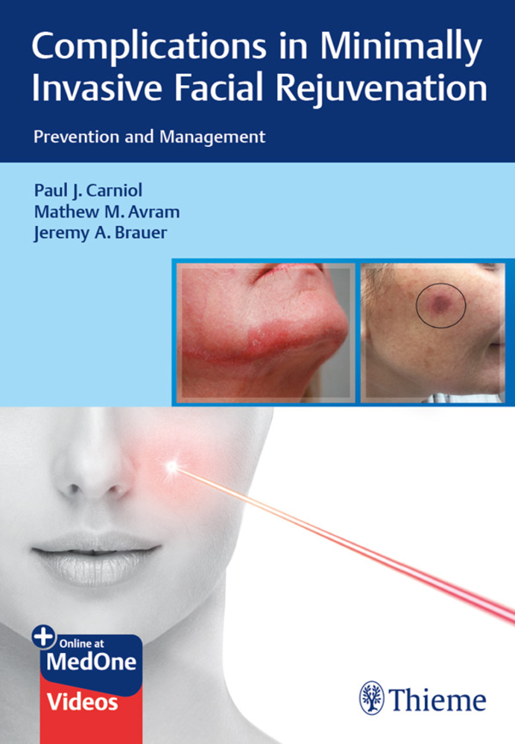 Complications in Minimally Invasive Facial Rejuvenation Prevention and Management 1st Edition