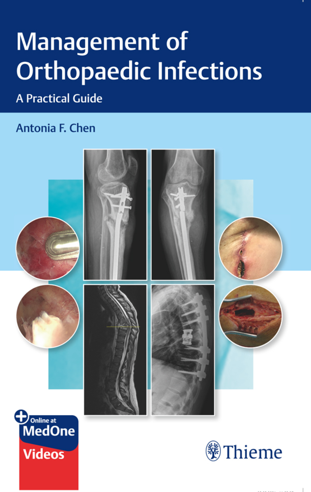 Management of Orthopaedic Infections A Practical Guide 1st Edition
