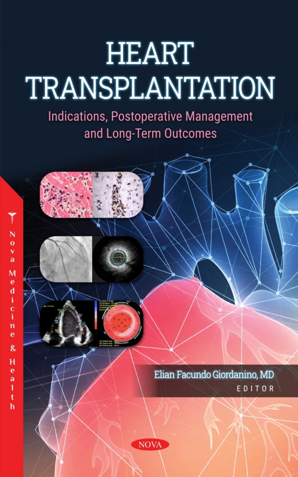 Heart Transplantation: Indications, Postoperative Management and Long-Term Outcomes 