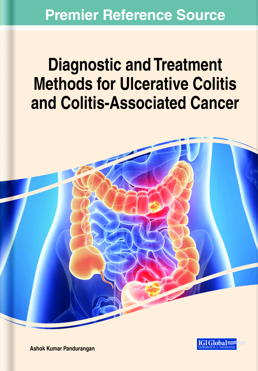Diagnostic and Treatment Methods for Ulcerative Colitis and Colitis-Associated Cancer 