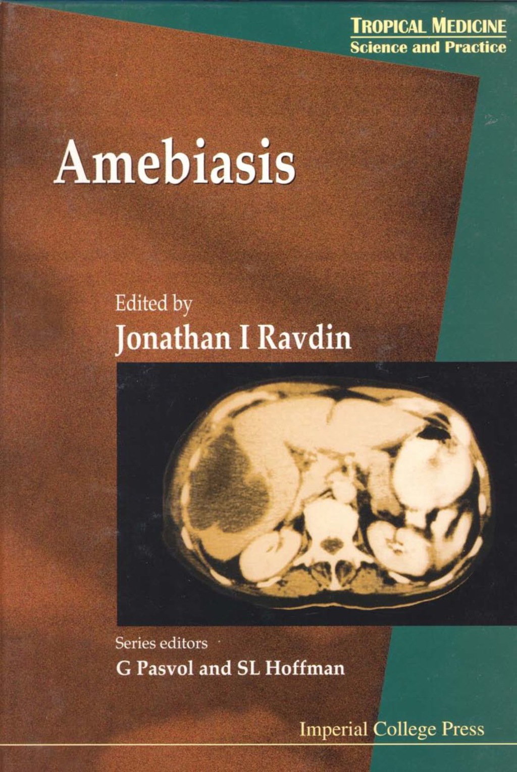 Amebiasis 