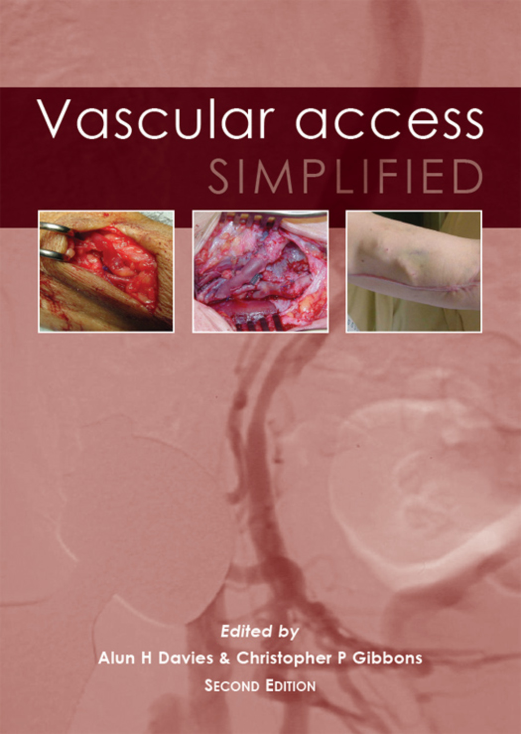 Vascular Access Simplified; second edition 2nd Edition