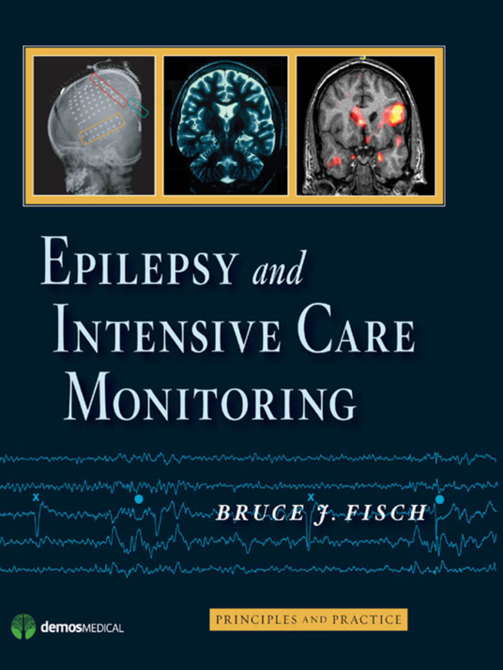 Epilepsy and Intensive Care Monitoring Principles and Practice 1st Edition