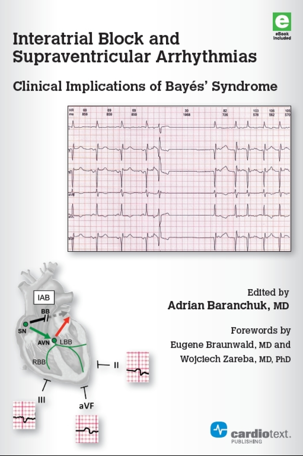 Interatrial Block and Supraventricular Arrhythmias: Clinical Implications of BayÃƒÂ©s Syndrome 1st Edition