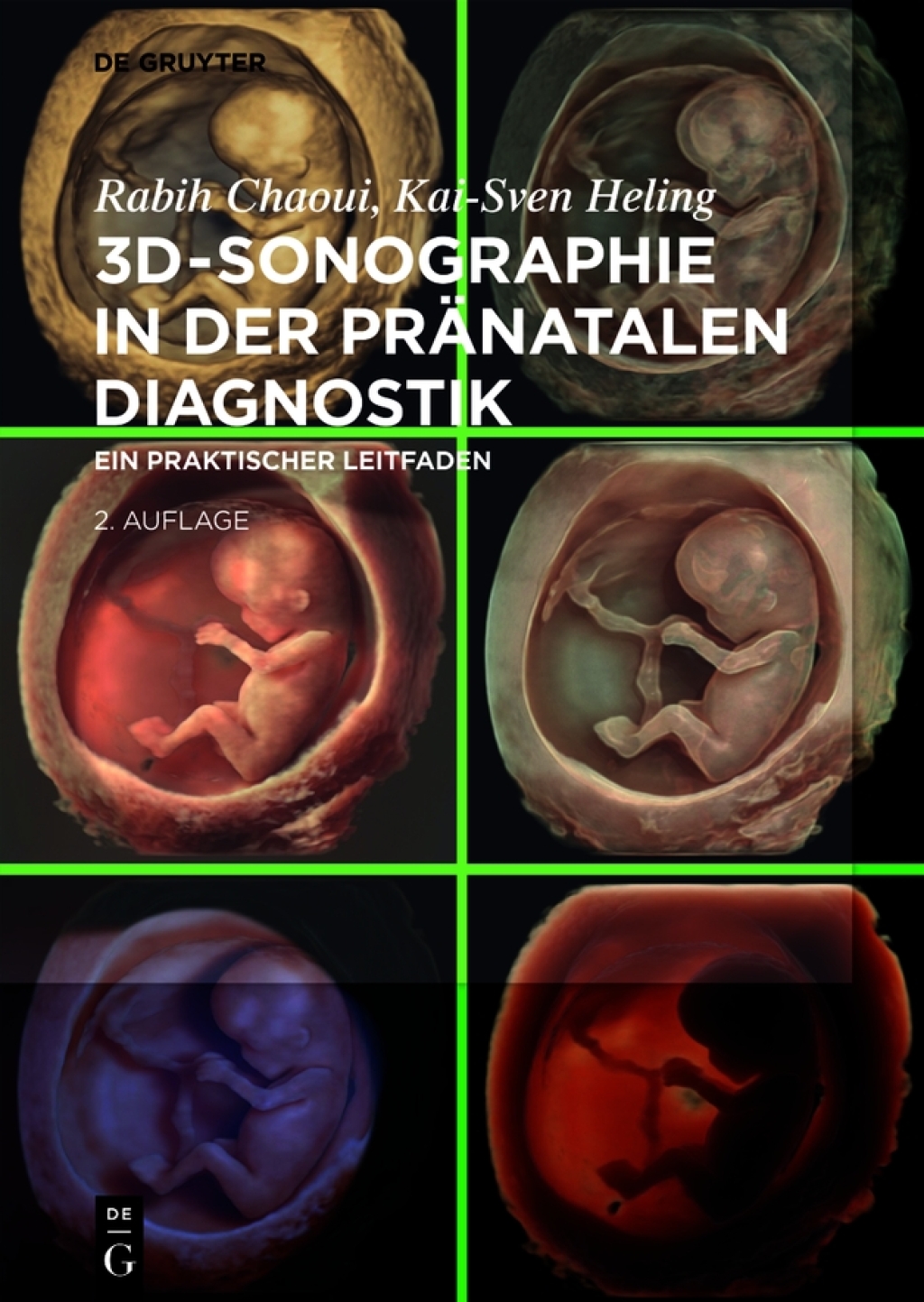 3D-Sonographie in der prÃƒÂ¤natalen Diagnostik Ein praktischer Leitfaden 2nd Edition