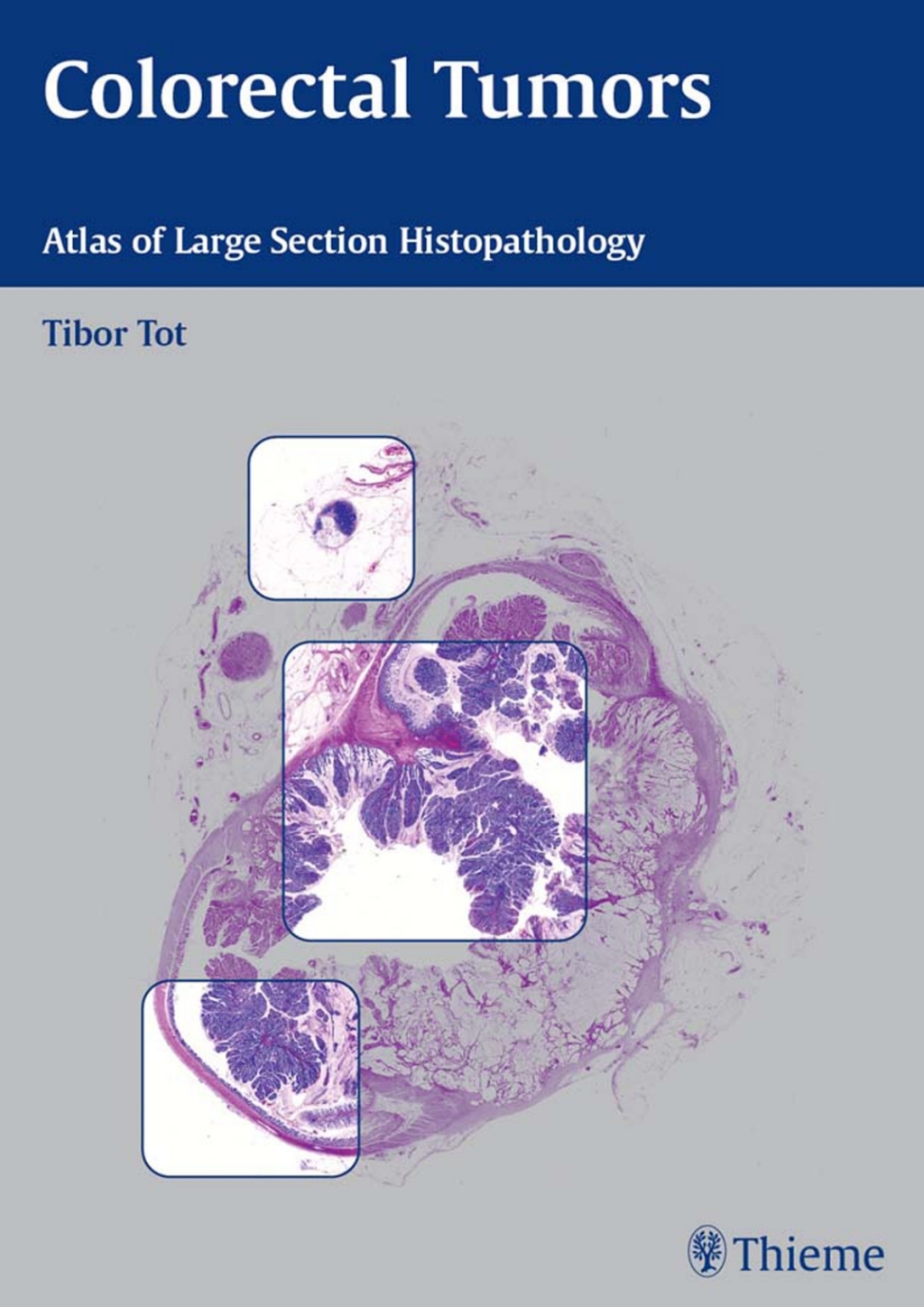 Colorectal Tumors Atlas of Large Section Histopathology 1st Edition