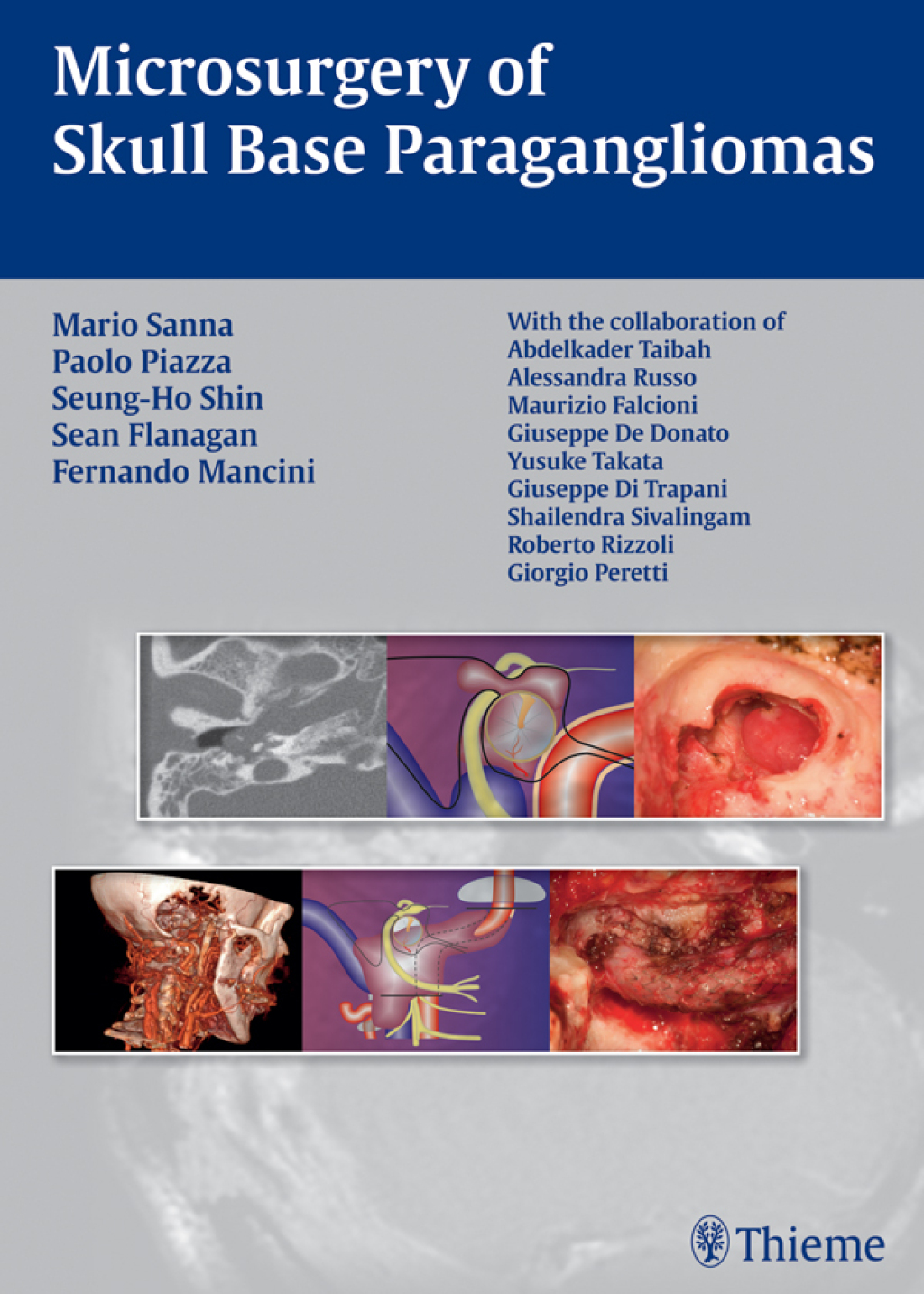 Microsurgery of Skull Base Paragangliomas 1st Edition