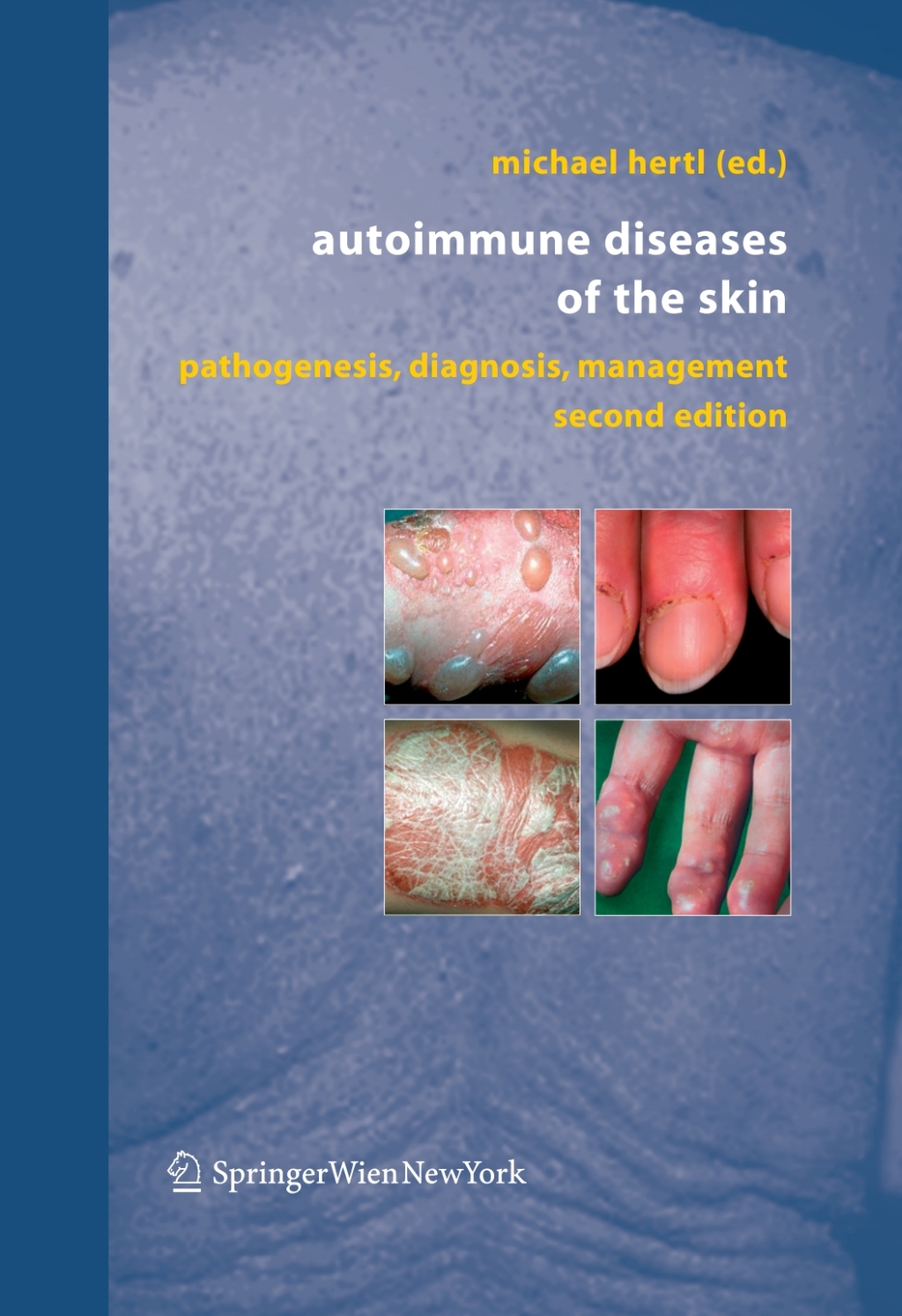 Autoimmune Diseases of the Skin Pathogenesis, Diagnosis, Management 2nd Edition