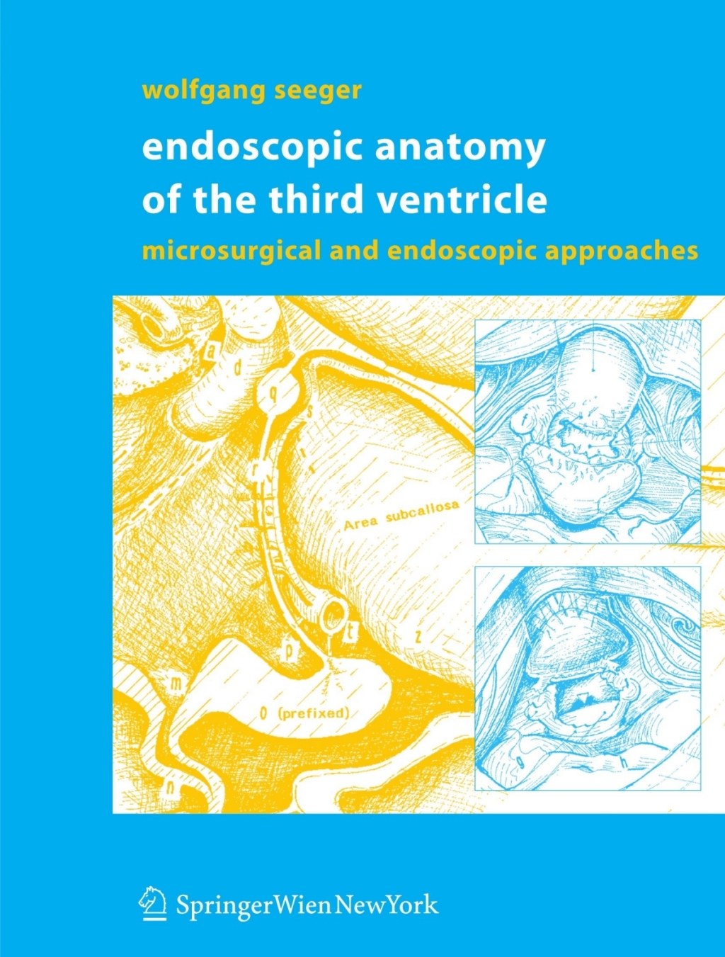 Endoscopic Anatomy of the Third Ventricle Microsurgical and Endoscopic Approaches 
