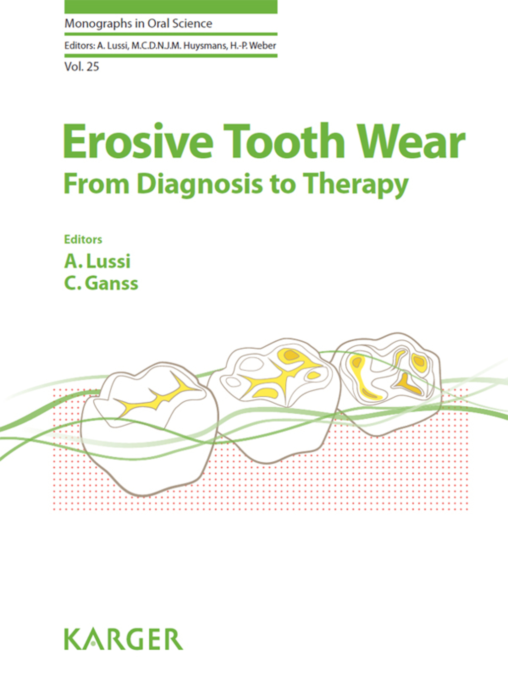 Erosive Tooth Wear From Diagnosis to Therapy 2nd Edition