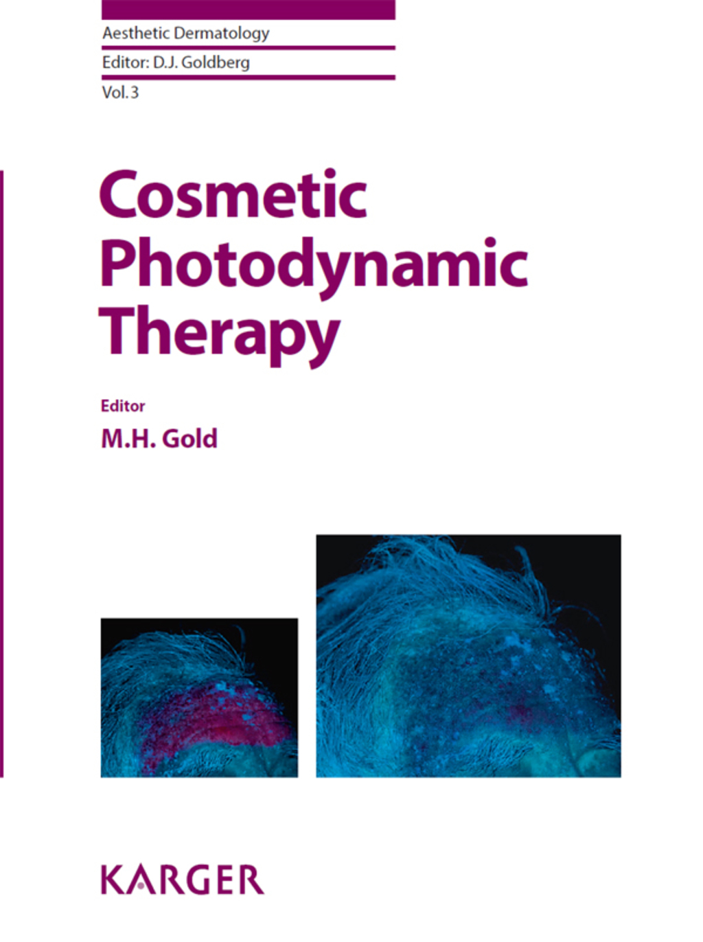 Cosmetic Photodynamic Therapy 1st Edition