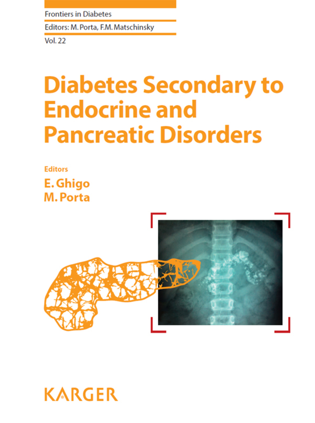 Diabetes Secondary to Endocrine and Pancreatic Disorders 1st Edition