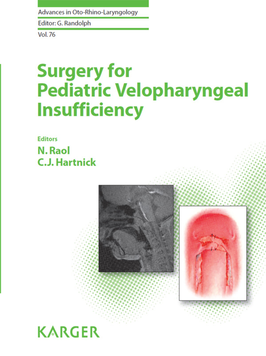 Surgery for Pediatric Velopharyngeal Insufficiency 1st Edition