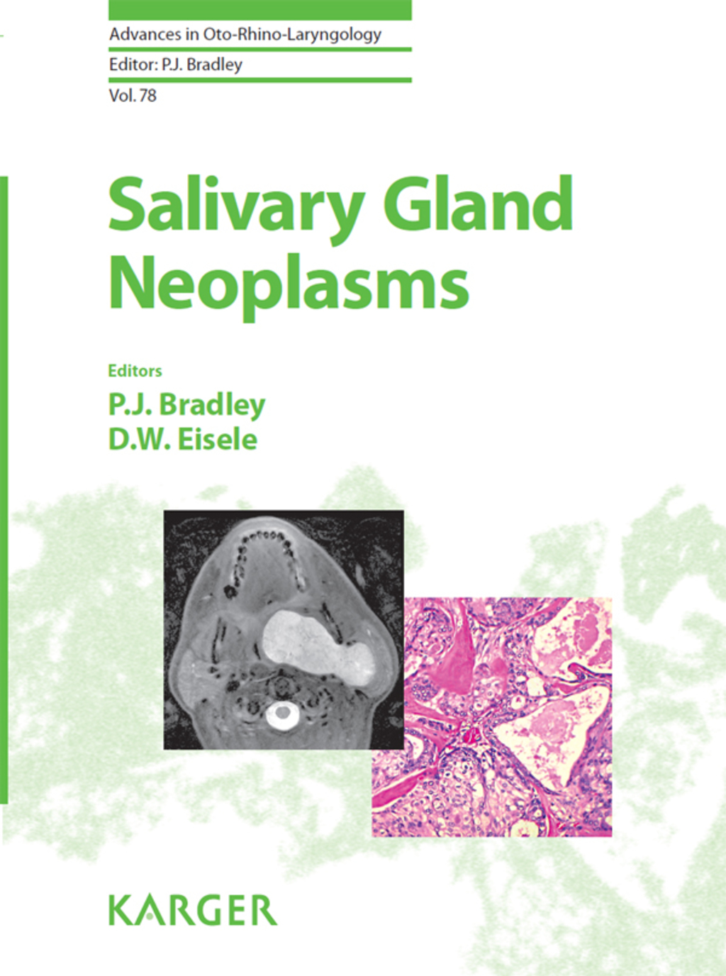 Salivary Gland Neoplasms 1st Edition
