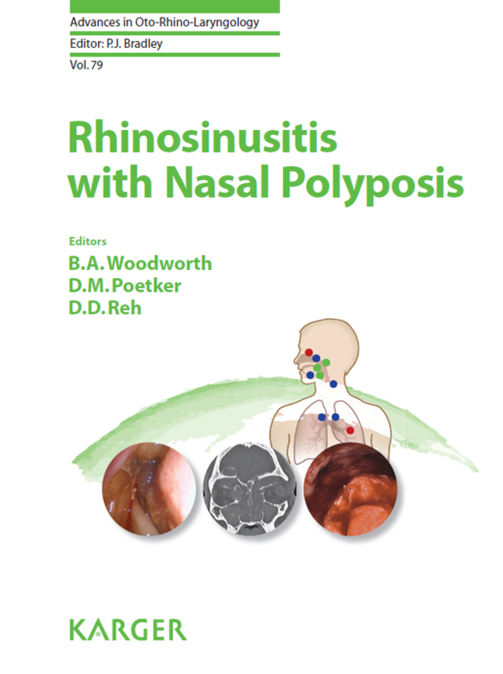 Rhinosinusitis with Nasal Polyposis With a foreword by D.W. Kennedy (Philadelphia, Pa.) 1st Edition