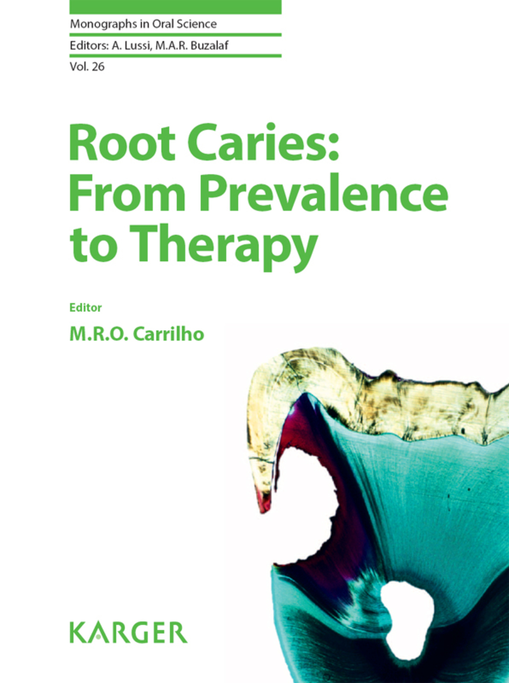Root Caries: From Prevalence to Therapy 1st Edition