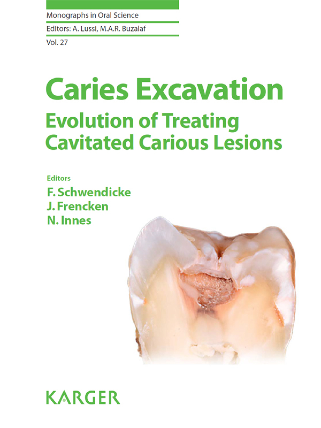 Caries Excavation: Evolution of Treating Cavitated Carious Lesions 1st Edition