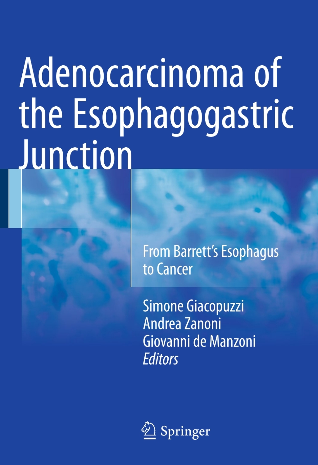 Adenocarcinoma of the Esophagogastric Junction From Barrett's Esophagus to Cancer 