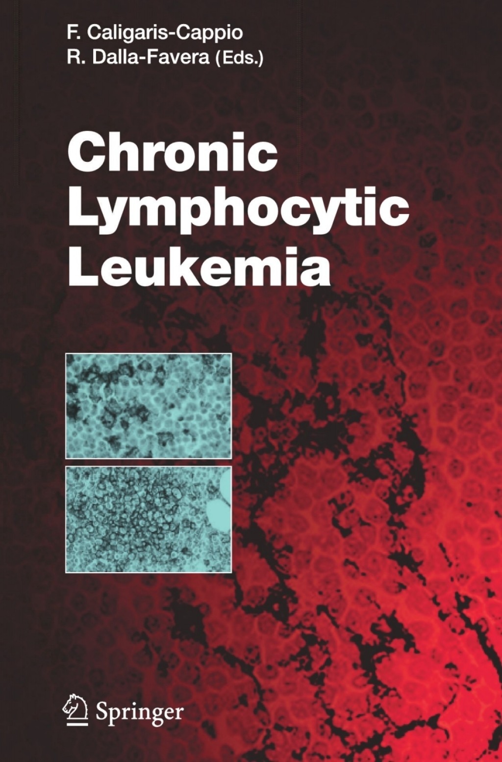 Chronic Lymphocytic Leukemia 1st Edition