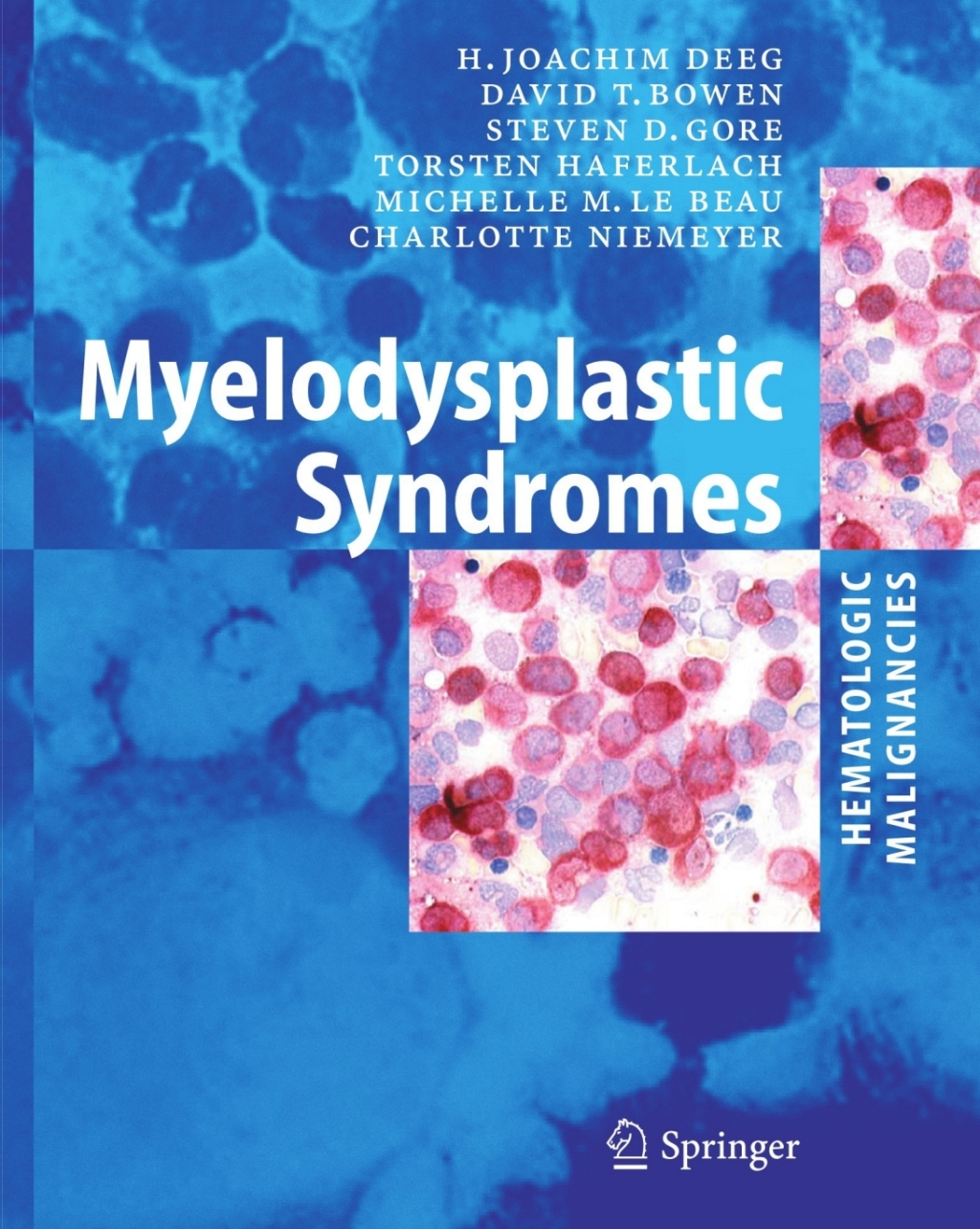 Myelodysplastic Syndromes 