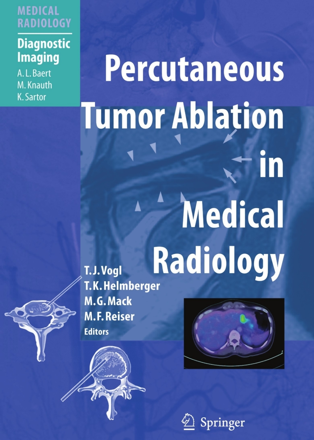 Percutaneous Tumor Ablation in Medical Radiology 1st Edition