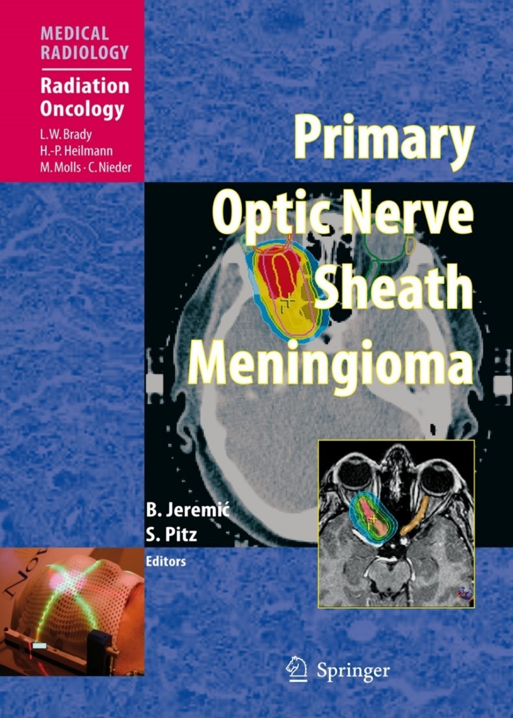 Primary Optic Nerve Sheath Meningioma 1st Edition