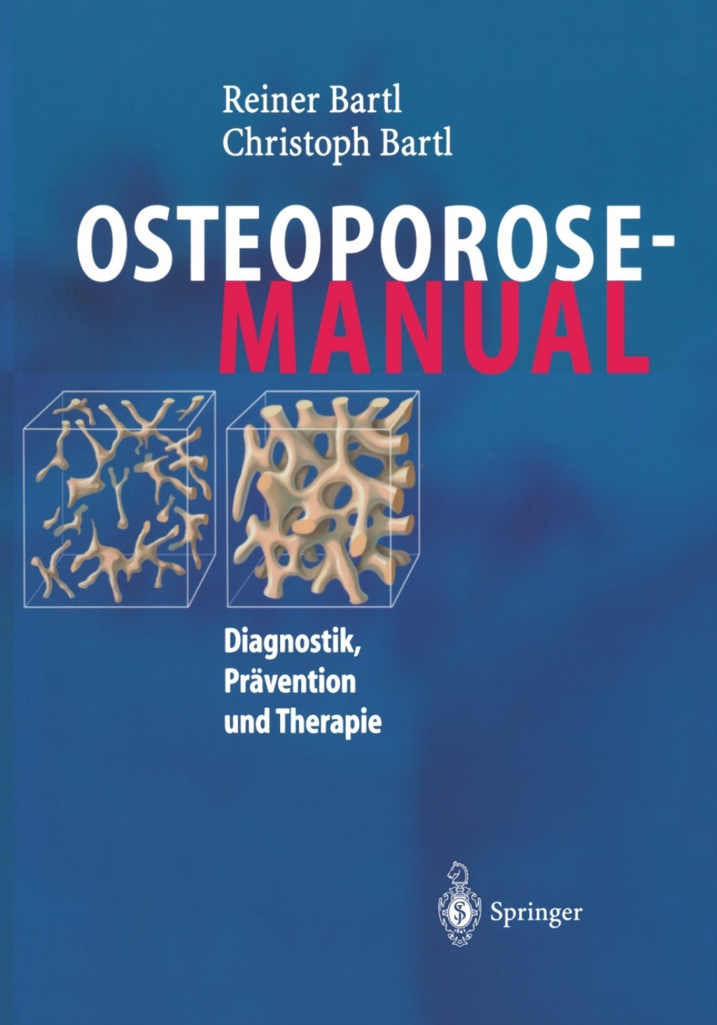 Osteoporose-Manual Diagnostik, PrÃƒÂ¤vention und Therapie 