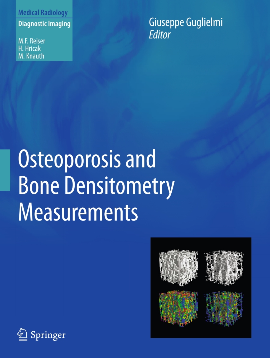 Osteoporosis and Bone Densitometry Measurements 