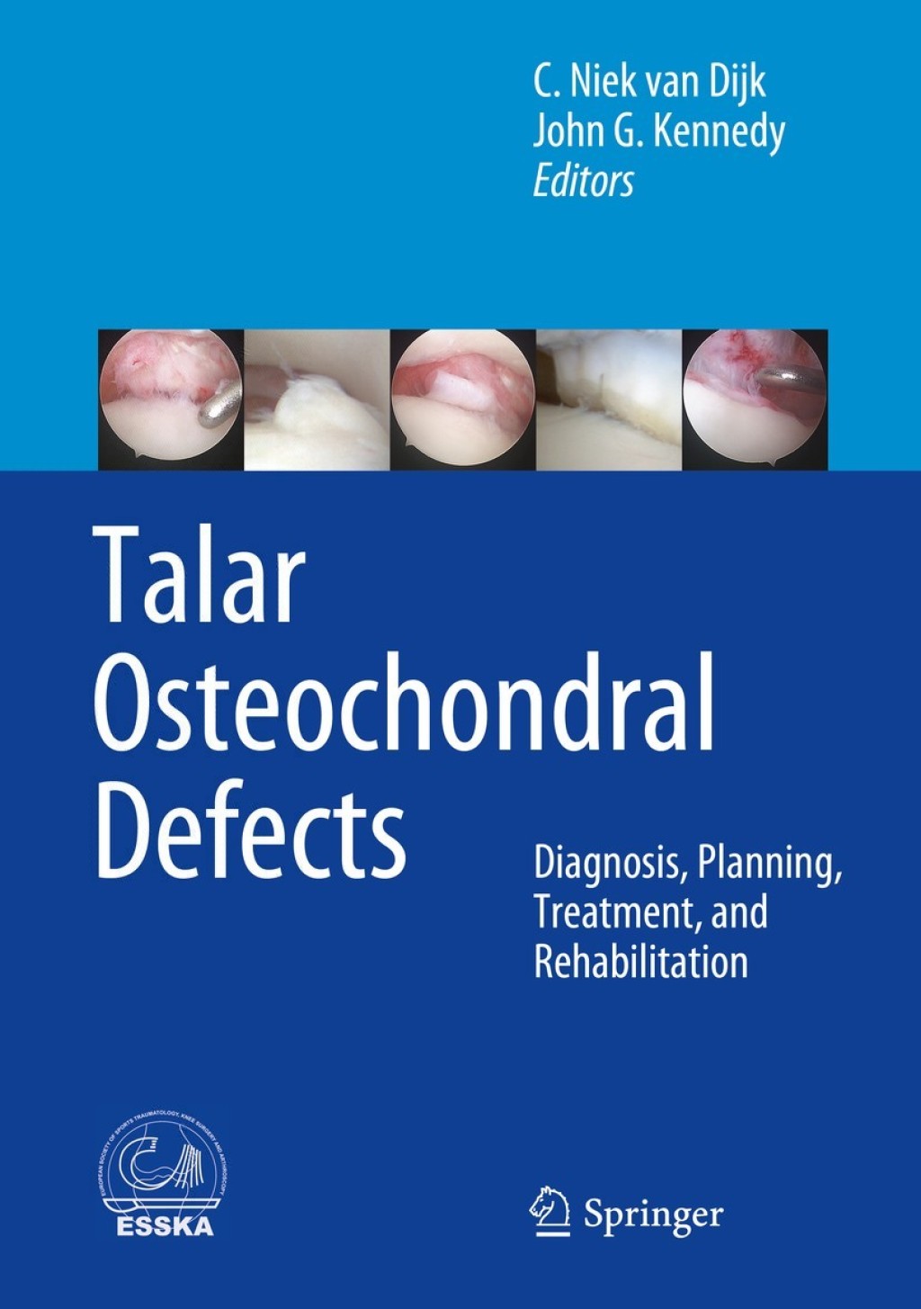 Talar Osteochondral Defects Diagnosis, Planning, Treatment, and Rehabilitation 