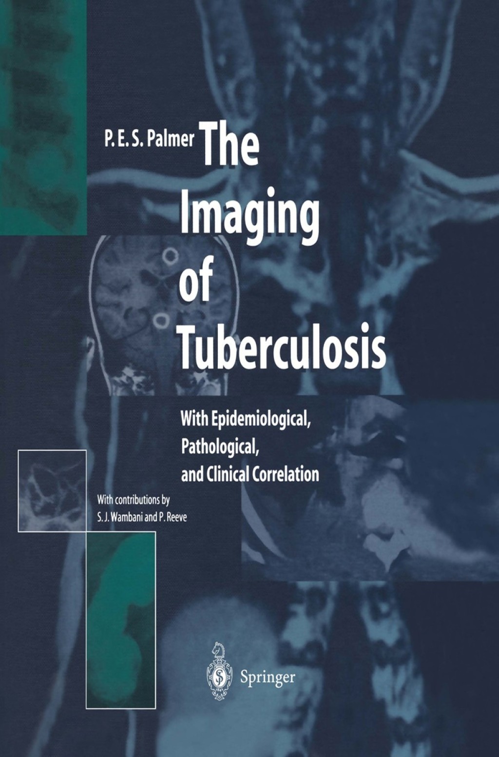 The Imaging of Tuberculosis With Epidemiological, Pathological, and Clinical Correlation 