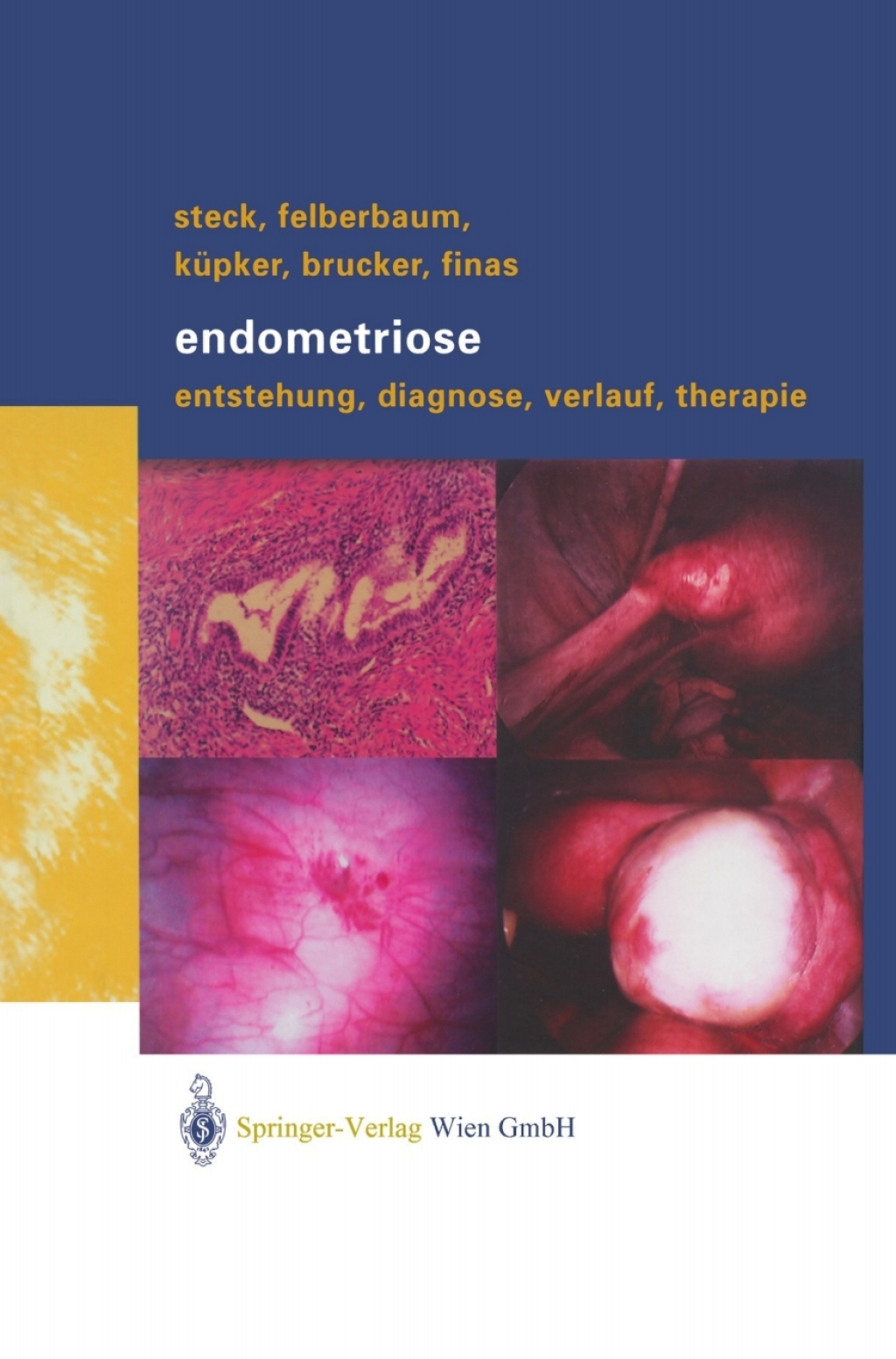 Endometriose Entstehung, Diagnose, Verlauf und Therapie 