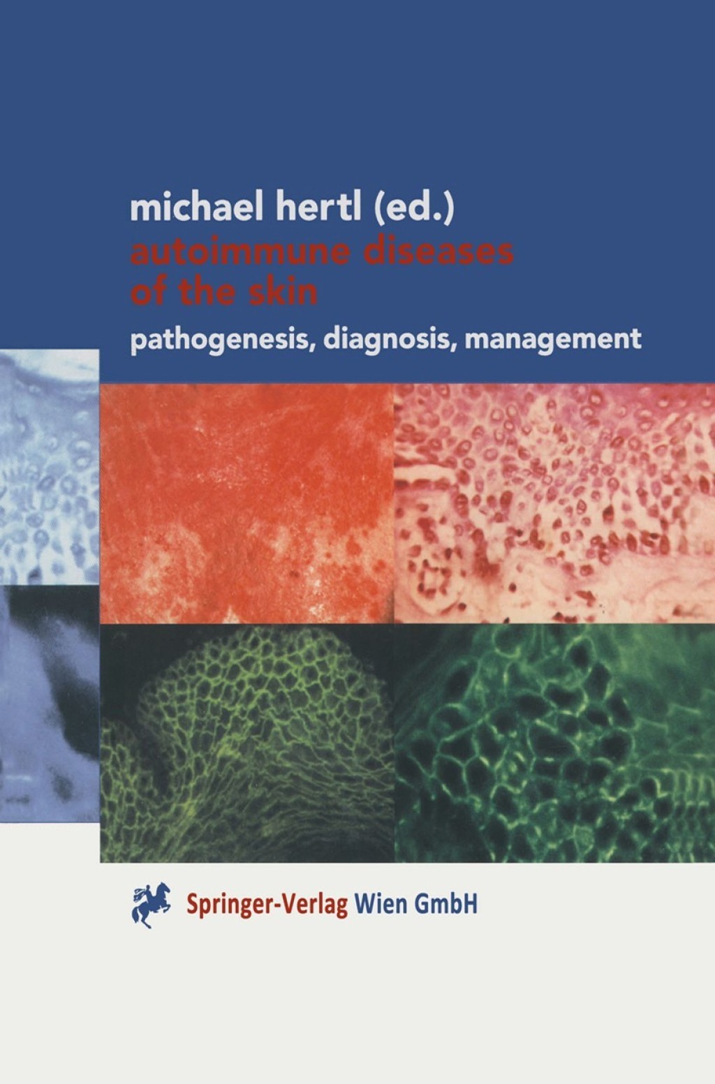 Autoimmune Diseases of the Skin Pathogenesis, Diagnosis, Management 1st Edition