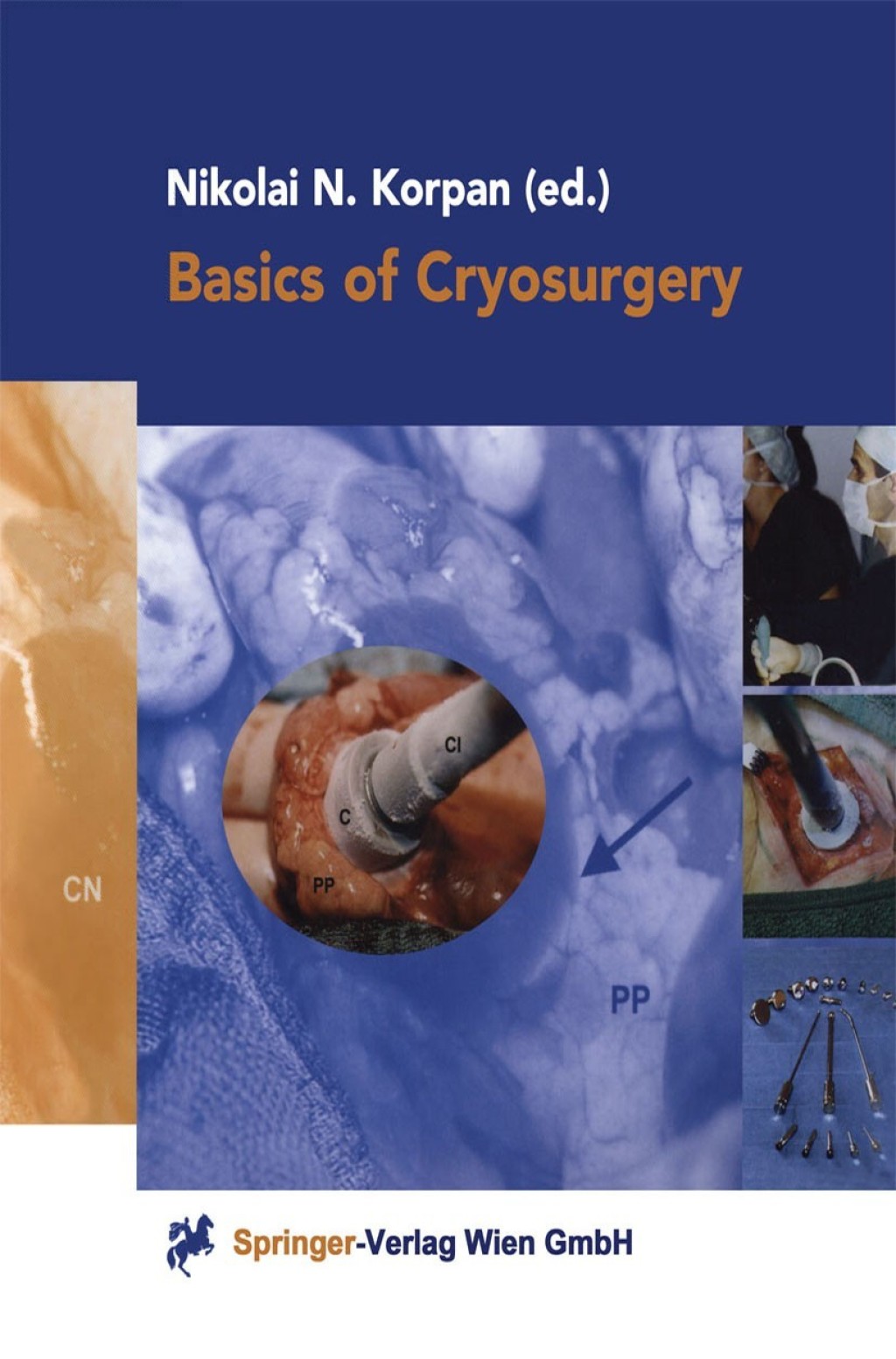 Basics of Cryosurgery 1st Edition