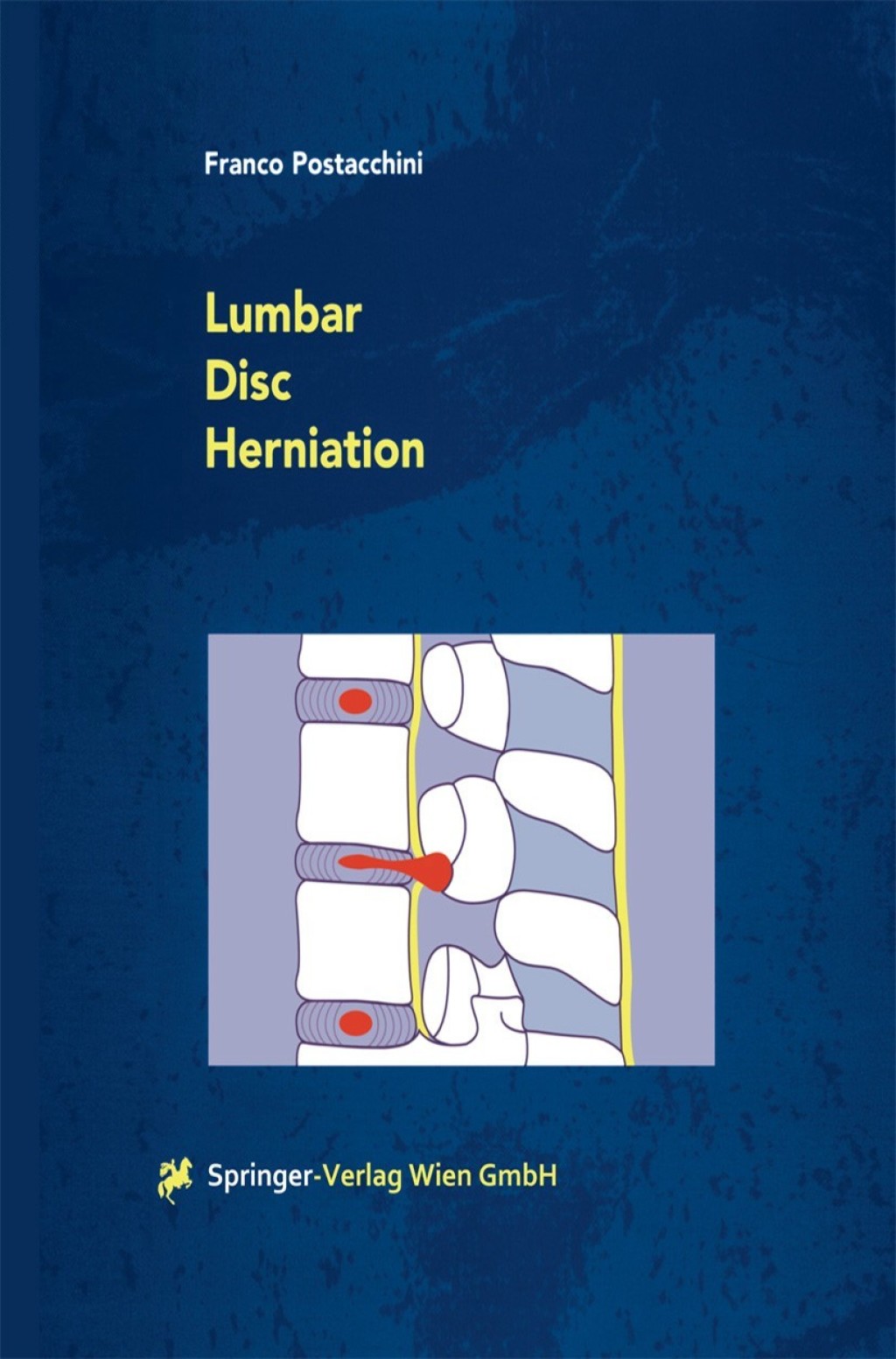 Lumbar Disc Herniation 