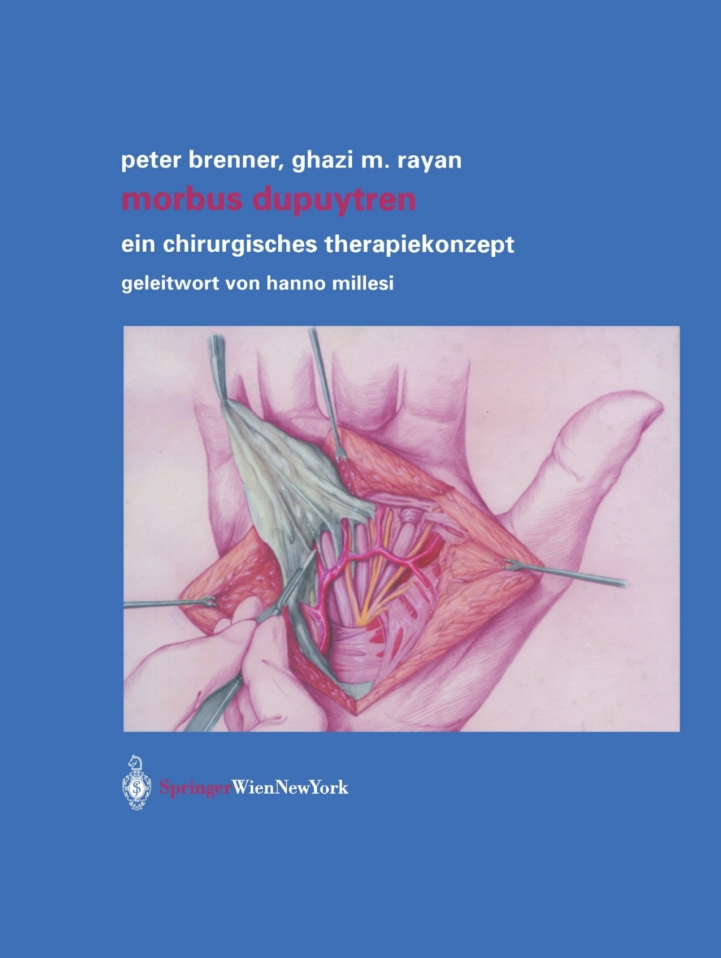 Morbus Dupuytren Ein chirurgisches Therapiekonzept 