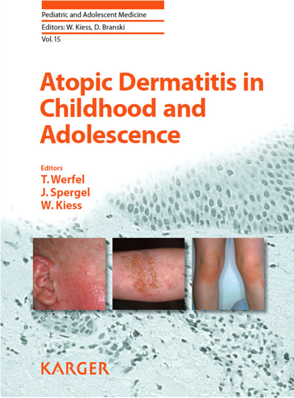 Atopic Dermatitis in Childhood and Adolescence 1st Edition
