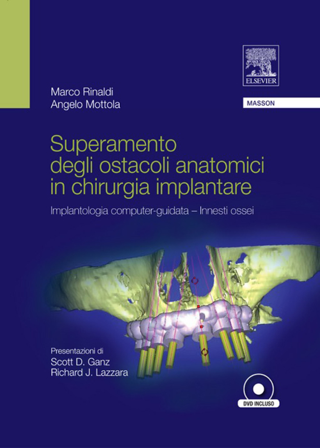 SUPERAMENTO DEGLI OSTACOLI ANATOMICI IN CHIURGIA IMPLANTARE implantologia computer-guidata - Innesti ossei 