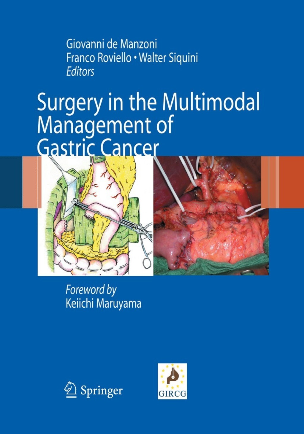 Surgery in the Multimodal Management of Gastric Cancer 1st Edition