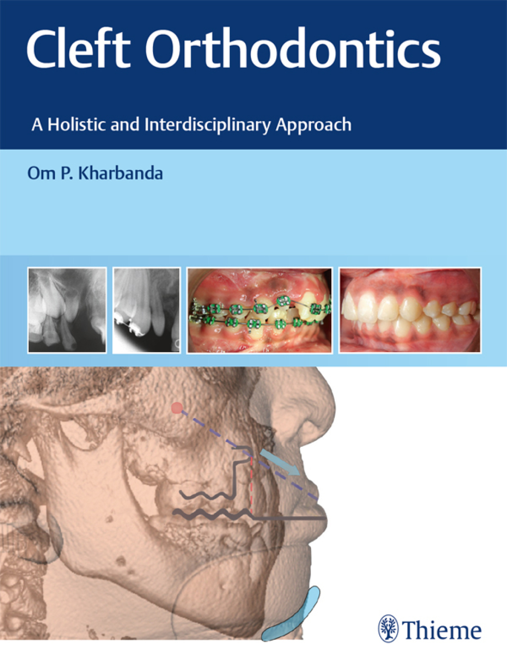 Cleft Orthodontics A Holistic and Interdisciplinary Approach 1st Edition