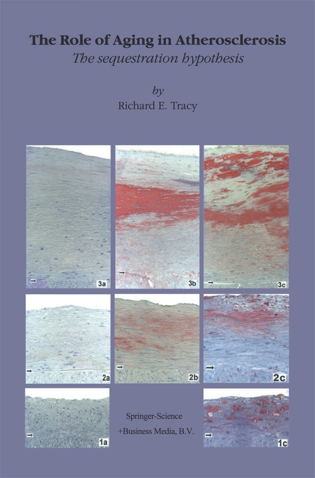The Role of Aging in Atherosclerosis The Sequestration Hypothesis 