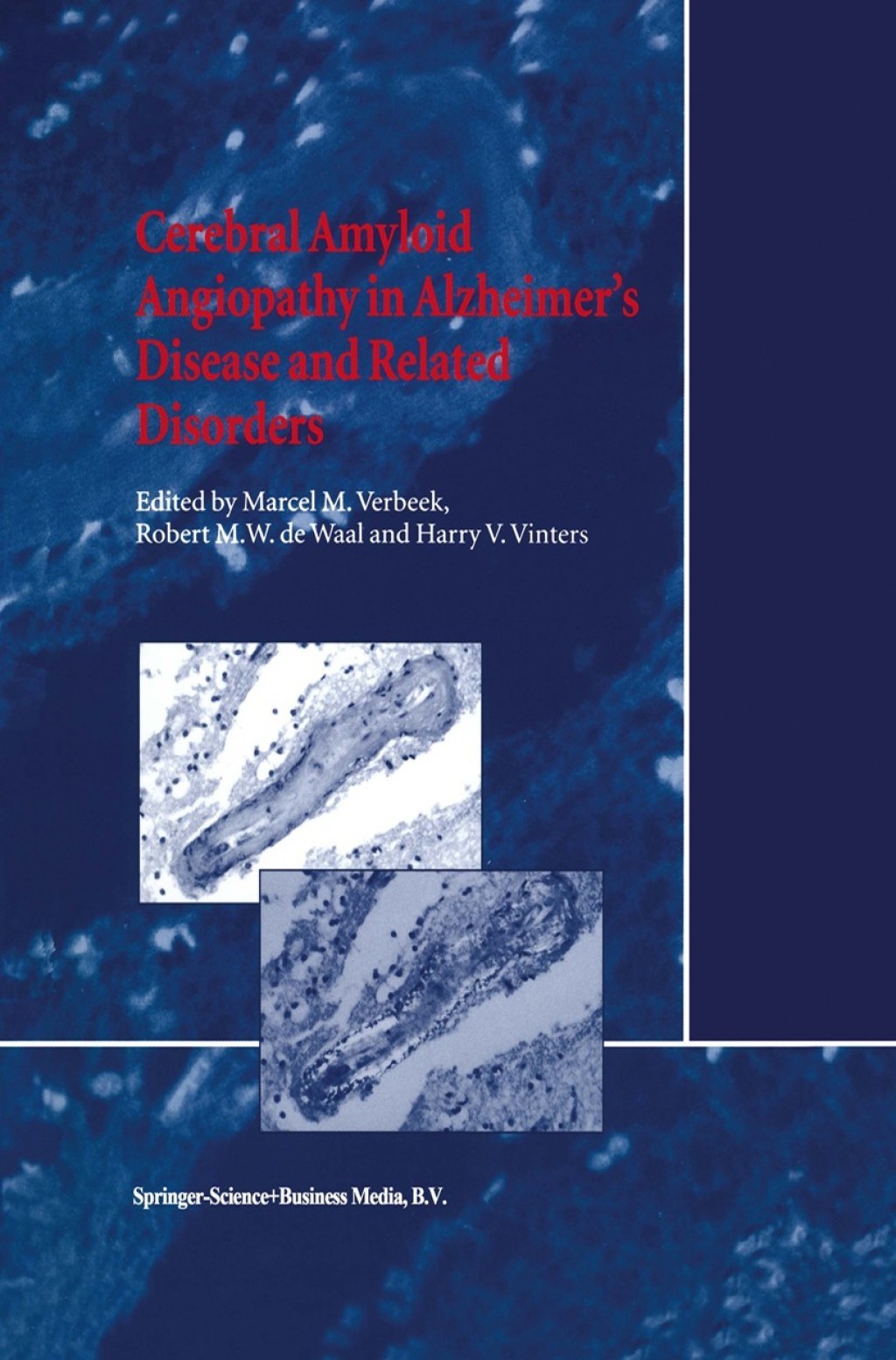 Cerebral Amyloid Angiopathy in AlzheimerÃ¢â‚¬â„¢s Disease and Related Disorders 1st Edition