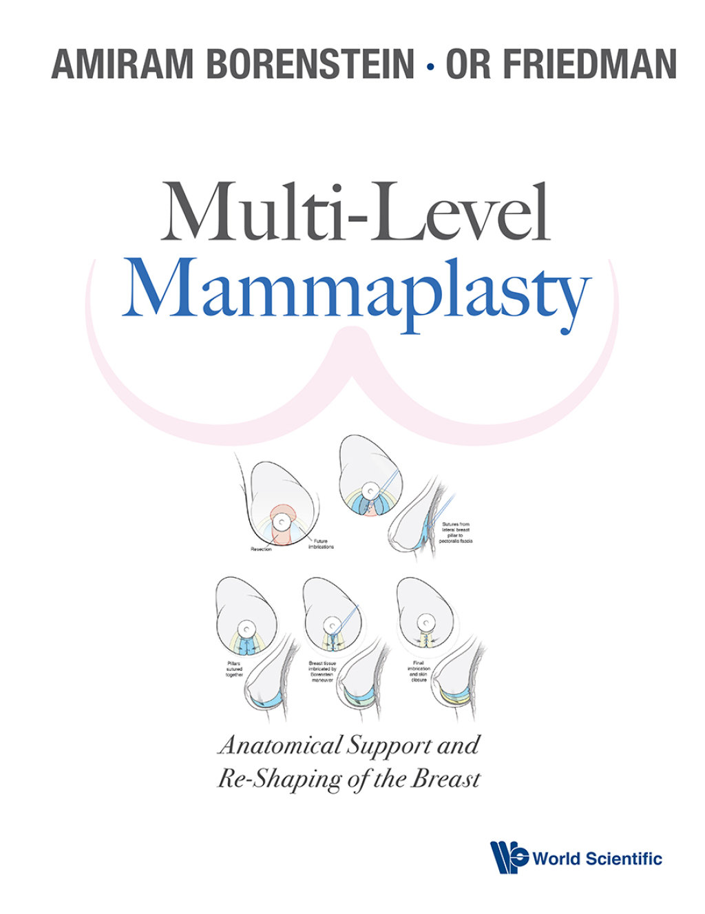 Multi-Level Mammaplasty: Anatomical Support and Re-Shaping of the Breast 