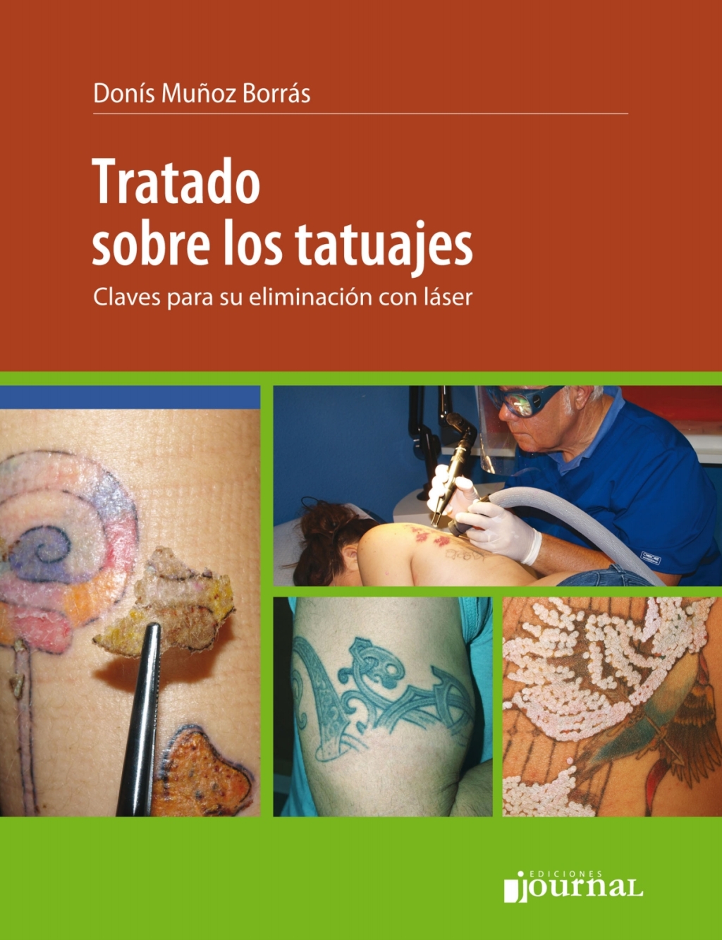 Tratado sobre los tatuajes: Claves sobre su eliminaciÃƒÂ³n con lÃƒÂ¡ser 1st Edition